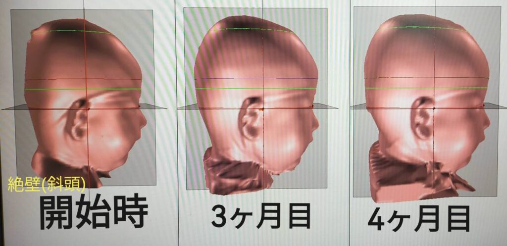 絶壁頭の治療経過